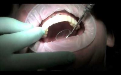 Full Mouth Implants & Restoration
