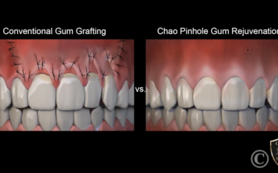 New Technique: Pinhole Gum Rejuvenation