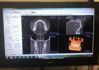 Route-66-Implants_-Technology