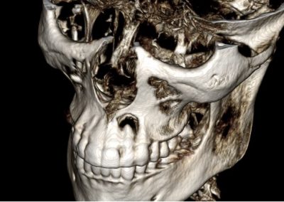 Bone grafts