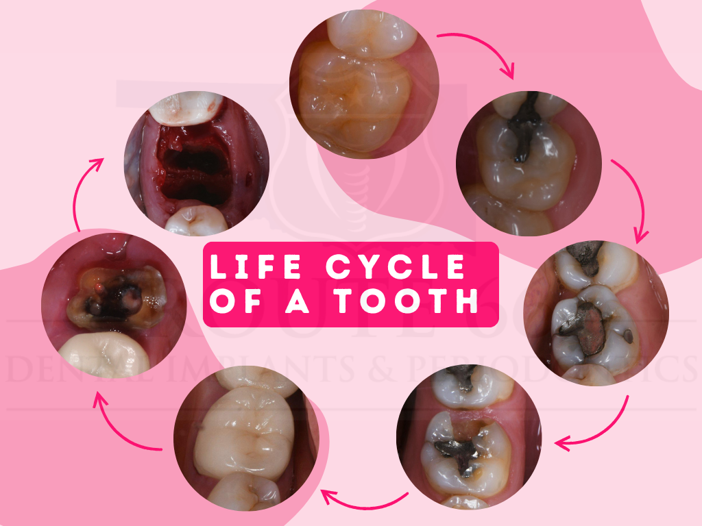 Life Cycle of a Tooth